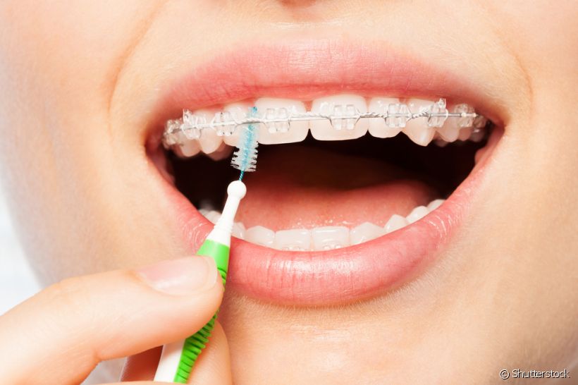 Limpeza interdental - Dentista SorriOrto São Leopoldo