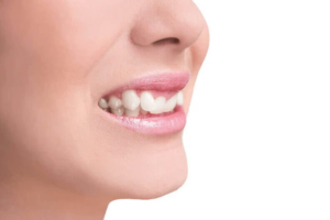 Má oclusão - Dentista São Leopoldo SorriOrto